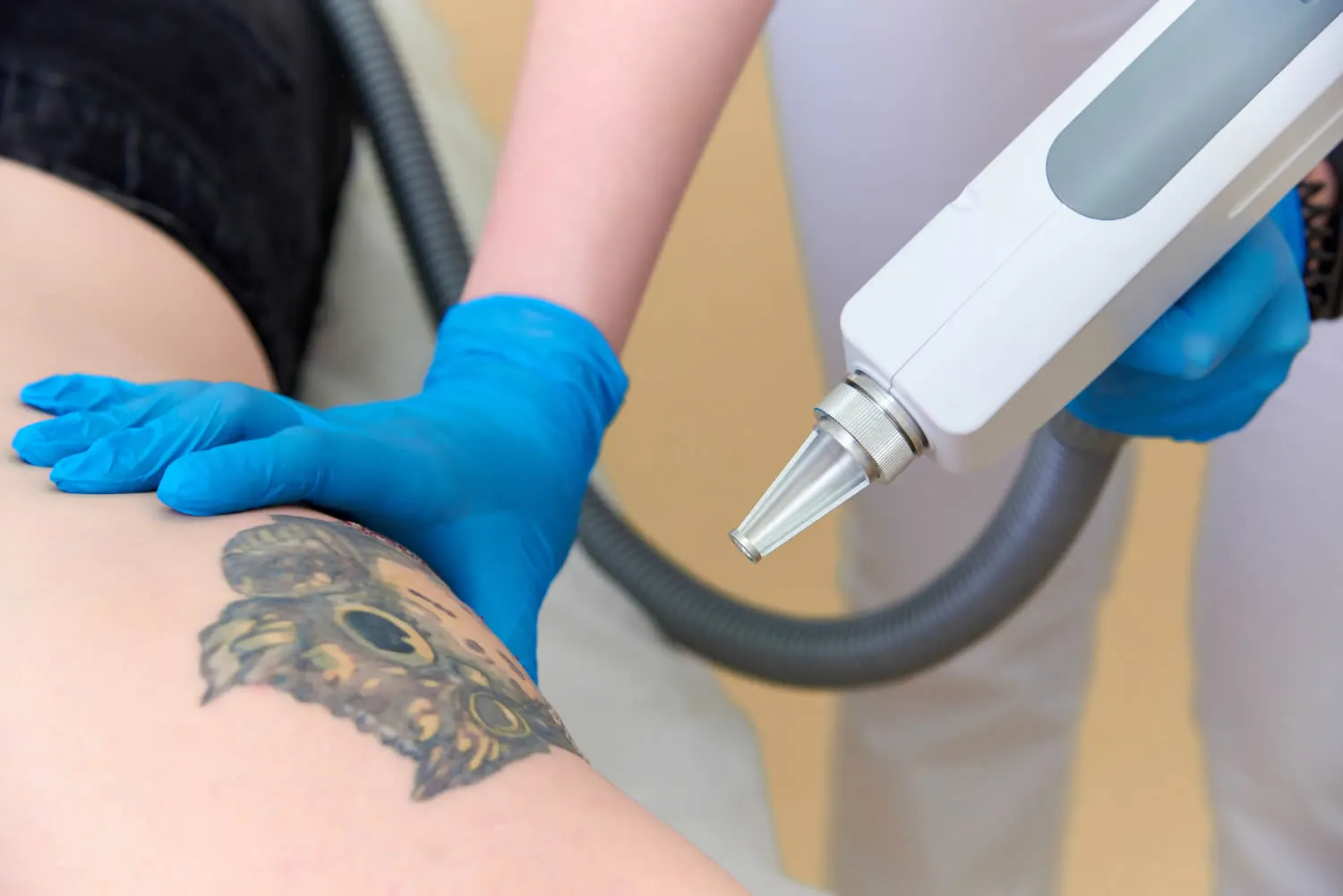 What To Expect When Getting A Tattoo Removed